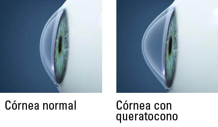 queratocono_crosslinking